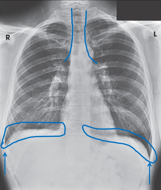 Radiografia frontal do tórax com estruturas anatômicas assinaladas