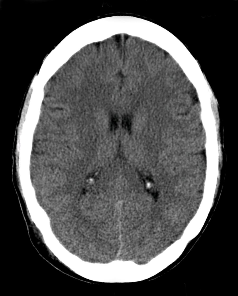 Corte axial de tomografia computadorizada do crânio